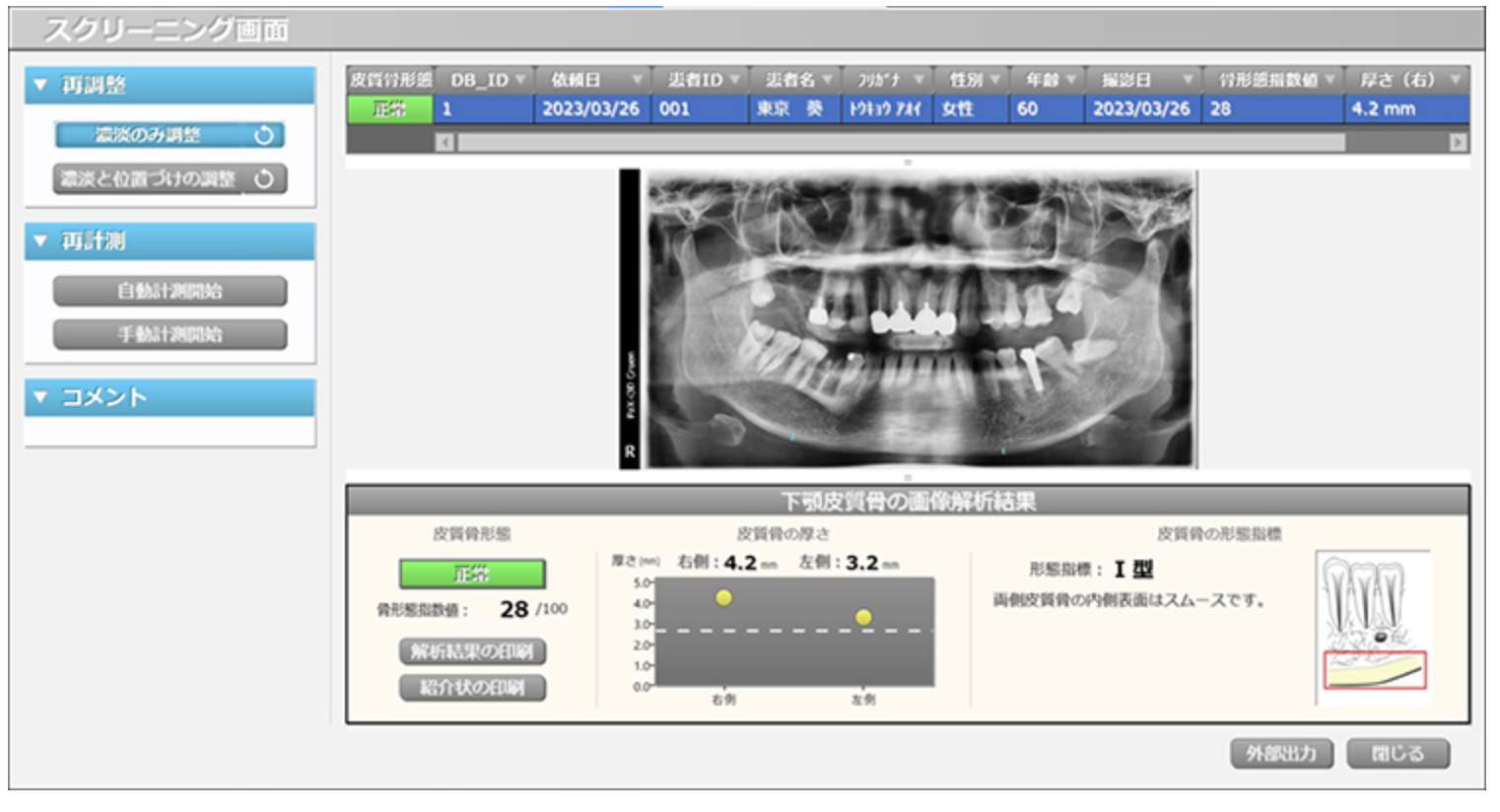 歯科レントゲンで「骨密度の危険信号」を可視化